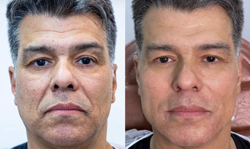 Maurício Mattar passa por harmonização facial, e médica fala sobre procedimento. — Foto: Reprodução / Instagram