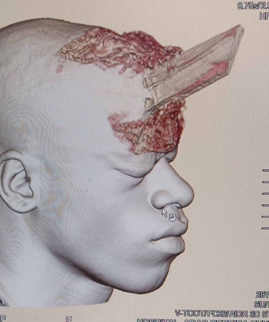 Imagem em 3D do ferimento provocado no crânio