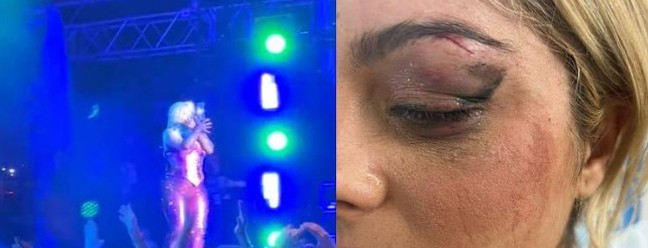 Bebe Rexha precisou interromper um show e chegou a levar pontos na região dos olhos após ter sido atingida por um celular em Nova York em junho deste ano; o agressor foi preso e disse que ter jogado o objeto porque 'pensou que seria engraçado' — Foto: Reprodução