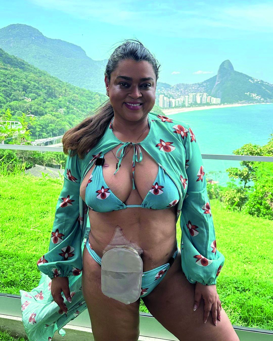 Preta Gil com a bolsa de ileostomia — Foto: Arquivo pessoal