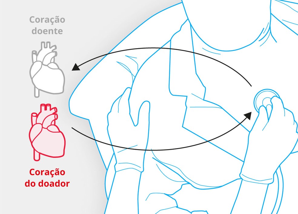 Médico constata a necessidade de transplante — Foto: Arte GLOBO