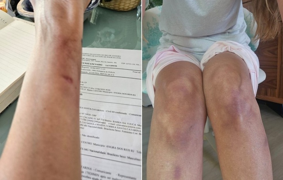 Psicóloga ficou com hematomas — Foto: Reprodução