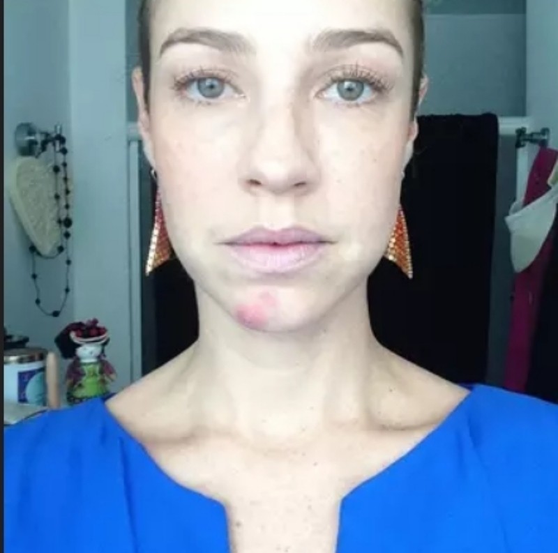 Luana Piovani já enfrentou problema com acne — Foto: Reprodução Instagram