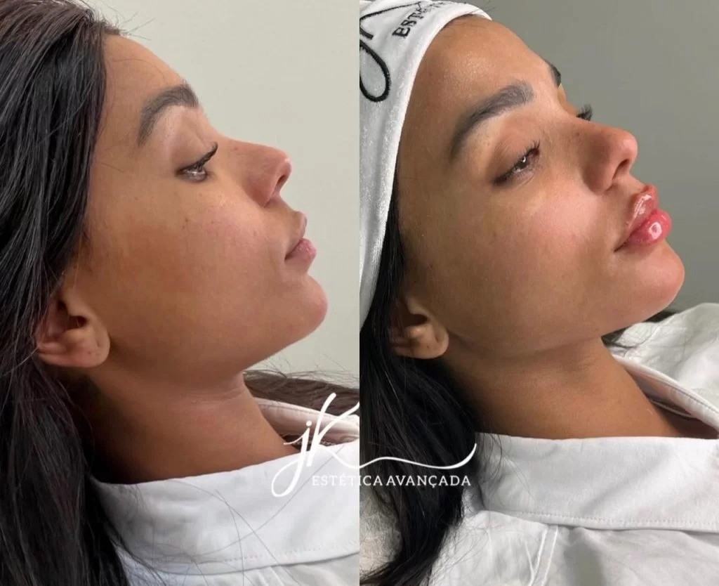 Brunna Gonçalves já havia feito diversos procedimentos estéticos antes do confinamento. Ao deixar a casa, retocou a harmonização facial e fez preenchimento labial — Foto: Reprodução/Instagram