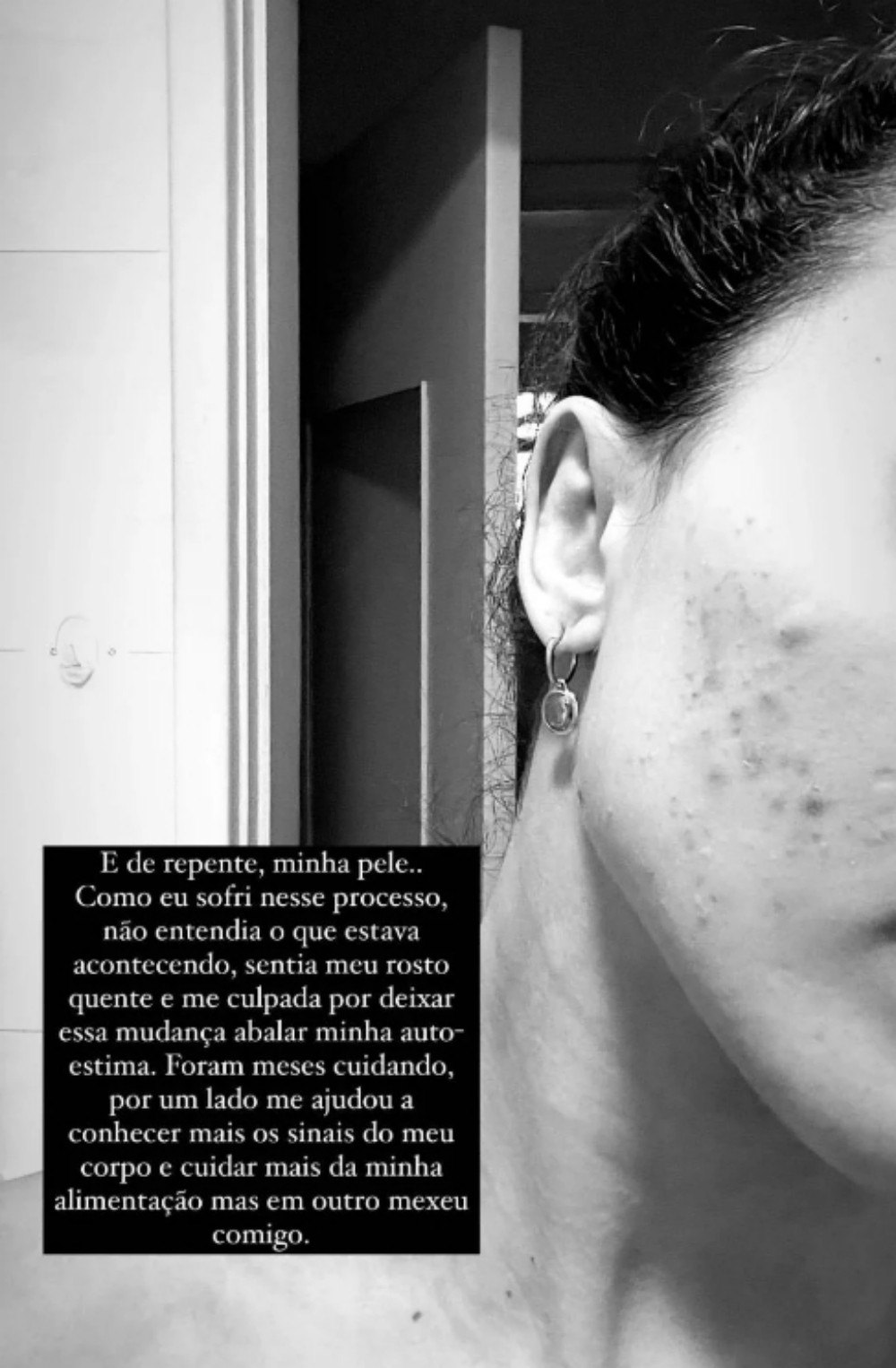 Rafa Kalimann já enfrentou problema com acne — Foto: Reprodução Instagram