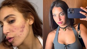 Veja os tratamentos mais e menos eficazes para acne, como a que afetou Vanessa Lopes