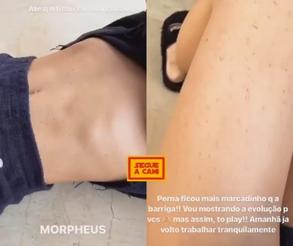 Morpheus: tratamento de pele preferido de Virgínia Fonseca e mais famosas — Foto: Reprodução @segueacami