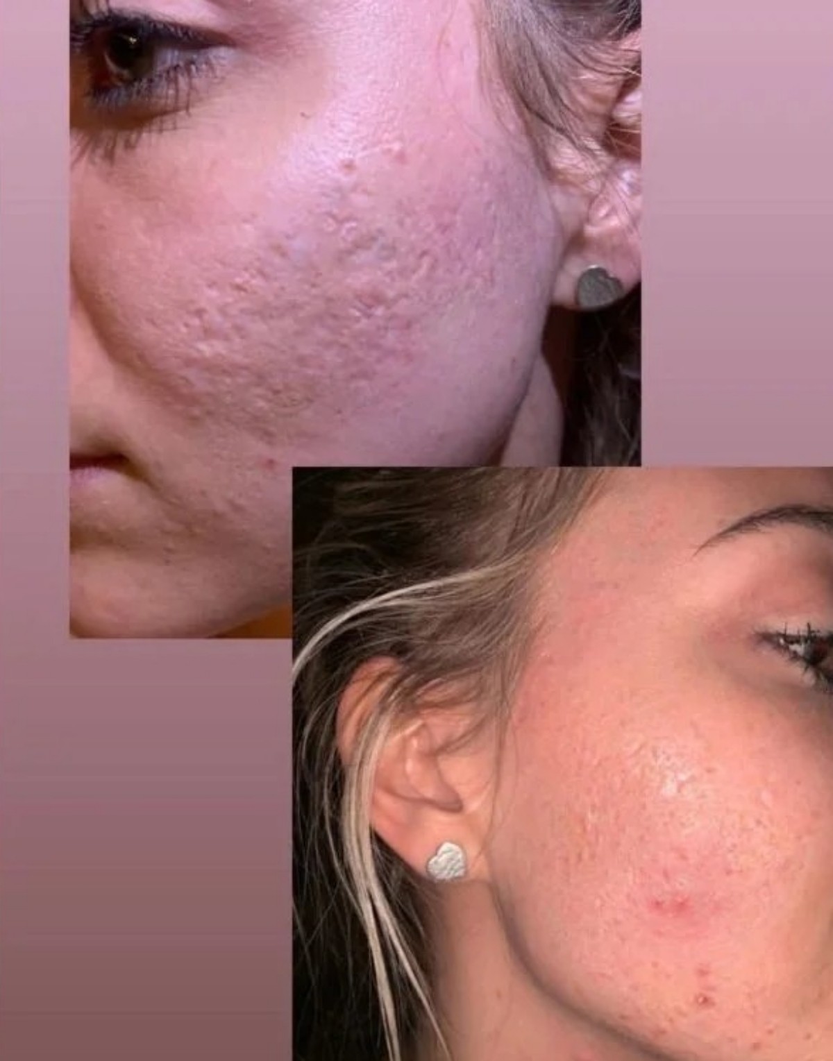 Tata Estaniecki já enfrentou problema com acne — Foto: Reprodução Instagram