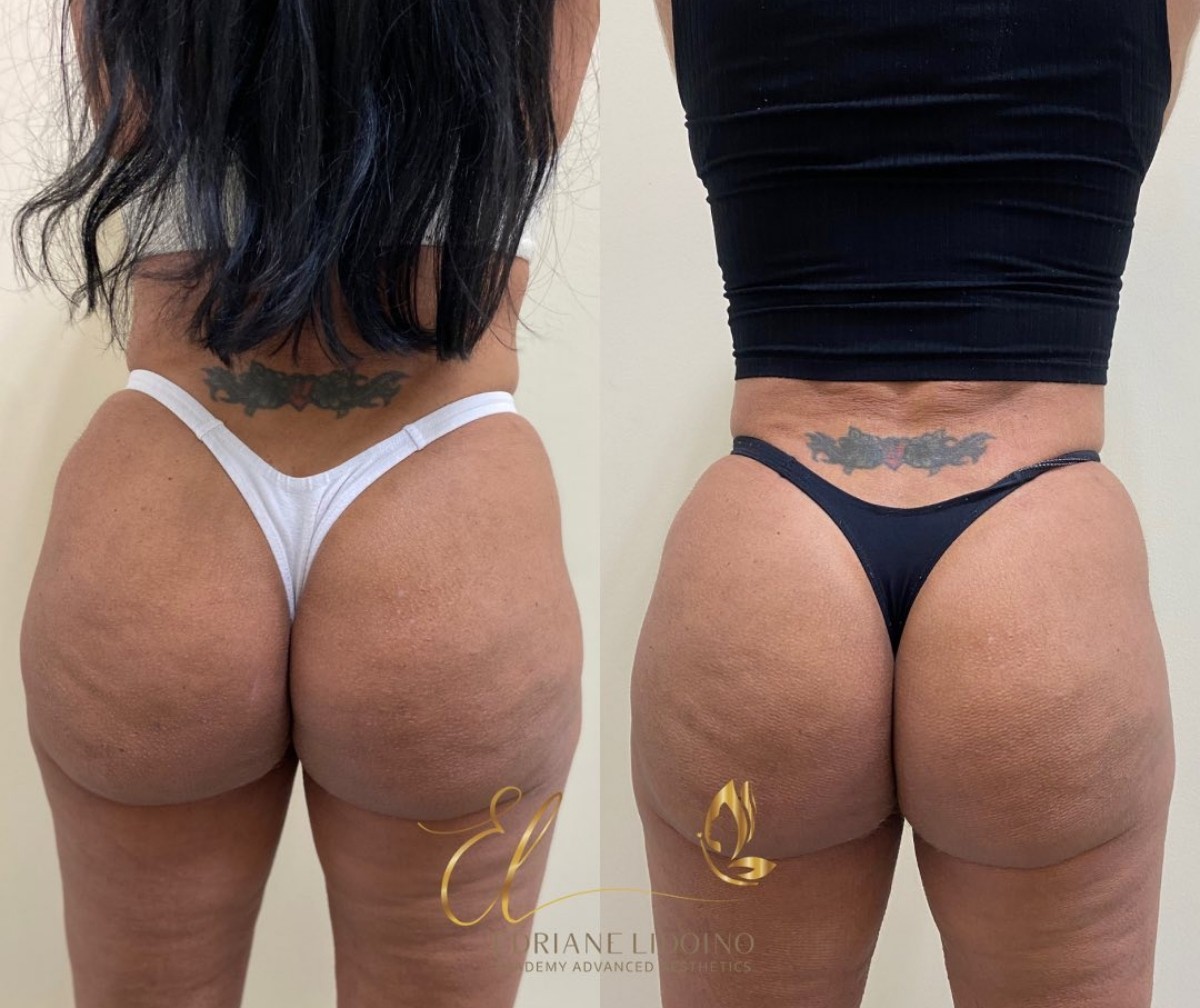 Gretchen exibiu antes e depois do bumbum ao fazer procedimento — Foto: Reprodução Instagram