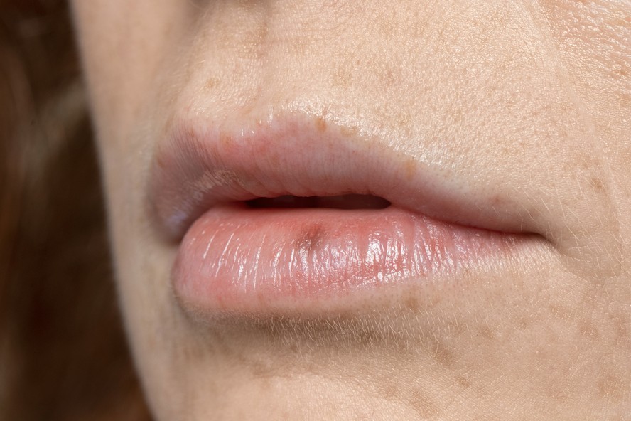 Herpes labial é uma infecção causada pelo vírus herpes simplex tipo 1