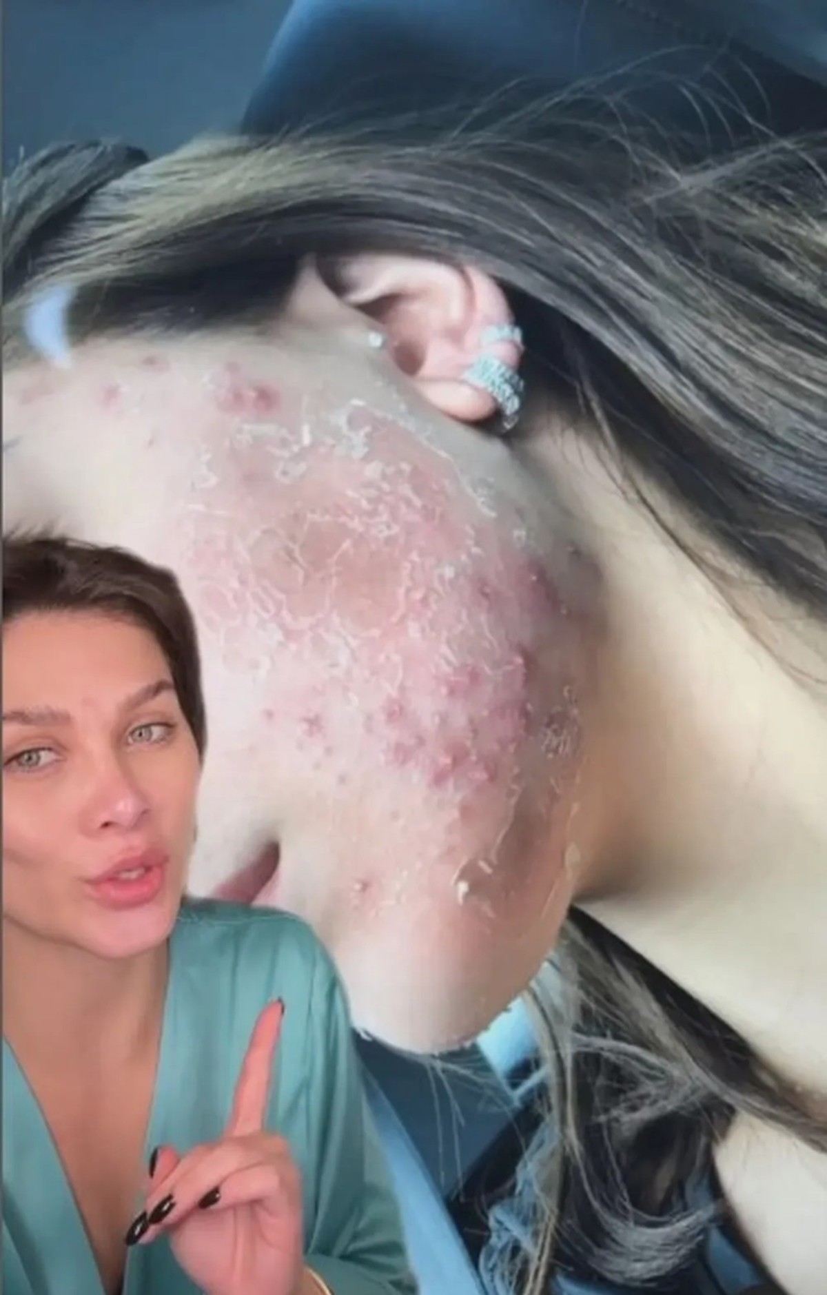Flavia Pavanelli já enfrentou problema com acne — Foto: Reprodução Instagram
