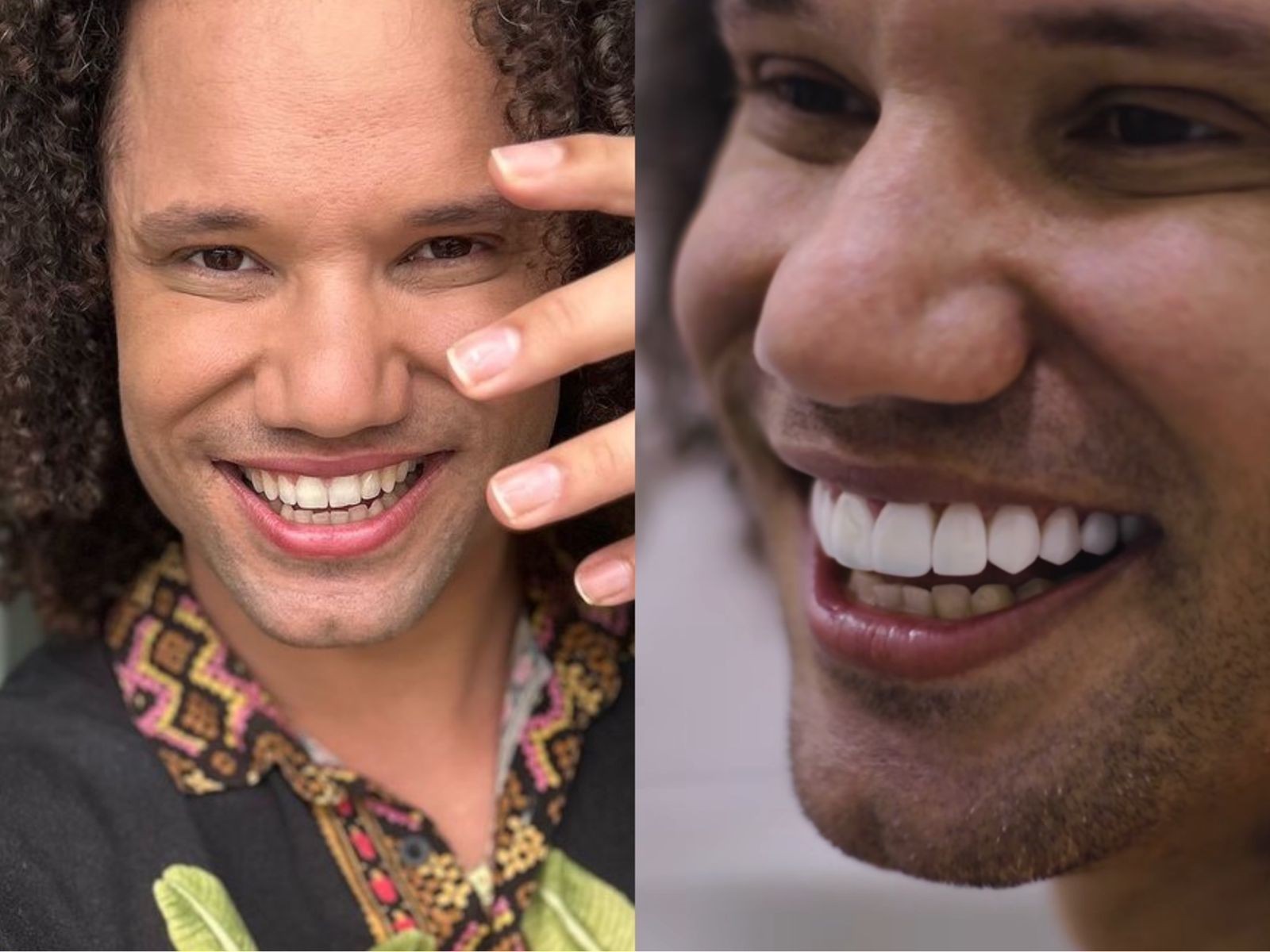 Antes e depois: Maycon, do "BBB 24", fez um procedimento estéticos nos dentes. — Foto: Reprodução/Instagram