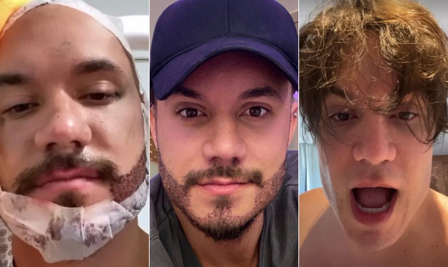 Eliezer em três tempos, da esquerda para a direita: durante cirurgia para transplante de barba; após o resultado do procedimento; e novamente sem barba