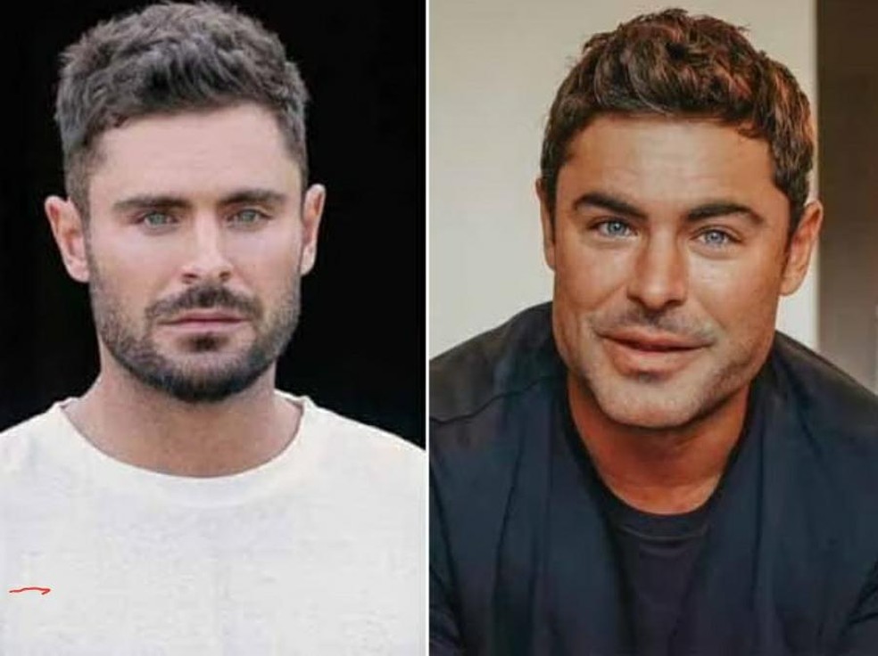 Transformação no rosto de Zac Efron foi causado por uma fratura na mandíbula. Ator precisou passar por cirurgia — Foto: Reprodução/ Instagram