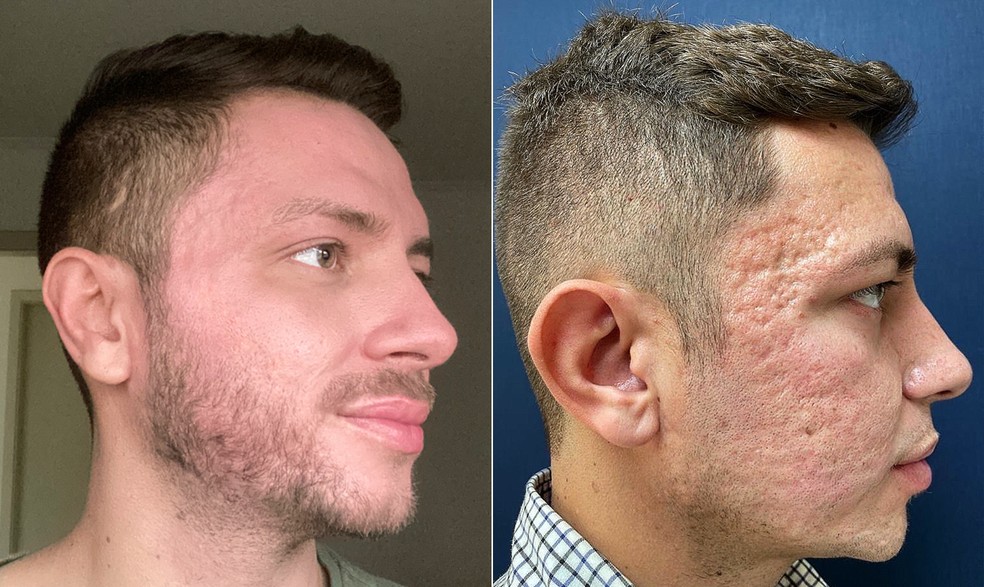 O fotógrafo João Castro em seu 'antes e depois' do peeling de fenol para amenizar cicatrizes de acne — Foto: Arquivo pessoal