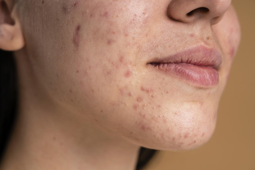 Acne é comum na faixa dos 30 e 40 anos