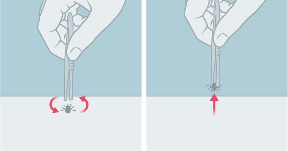 Como remover o carrapato. Arte O GLOBO — Foto: Arte O GLOBO