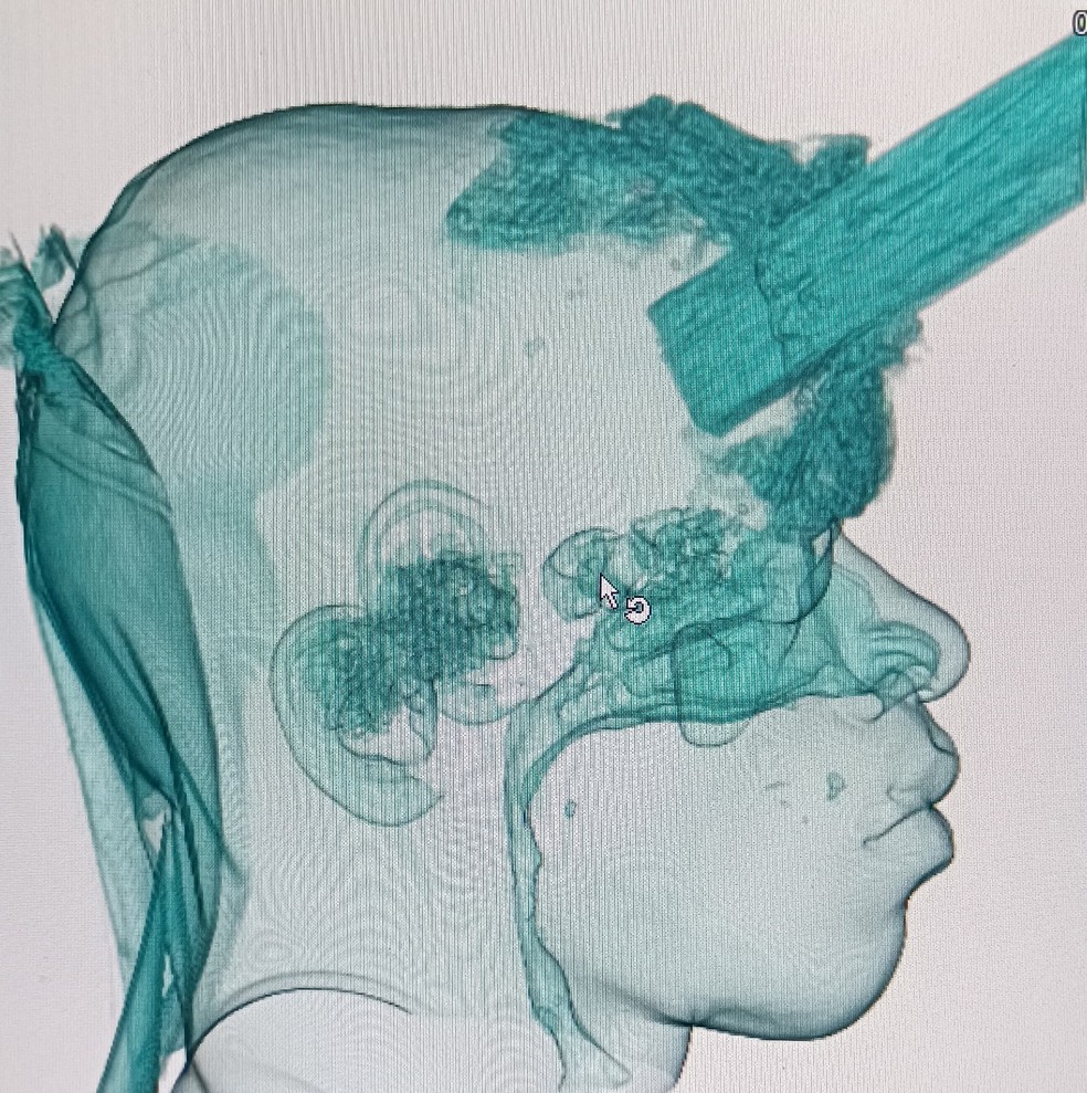 Imagem  mostra como ficou a estaca na cabeça de Vitor Soares do Nascimento — Foto: Reprodução