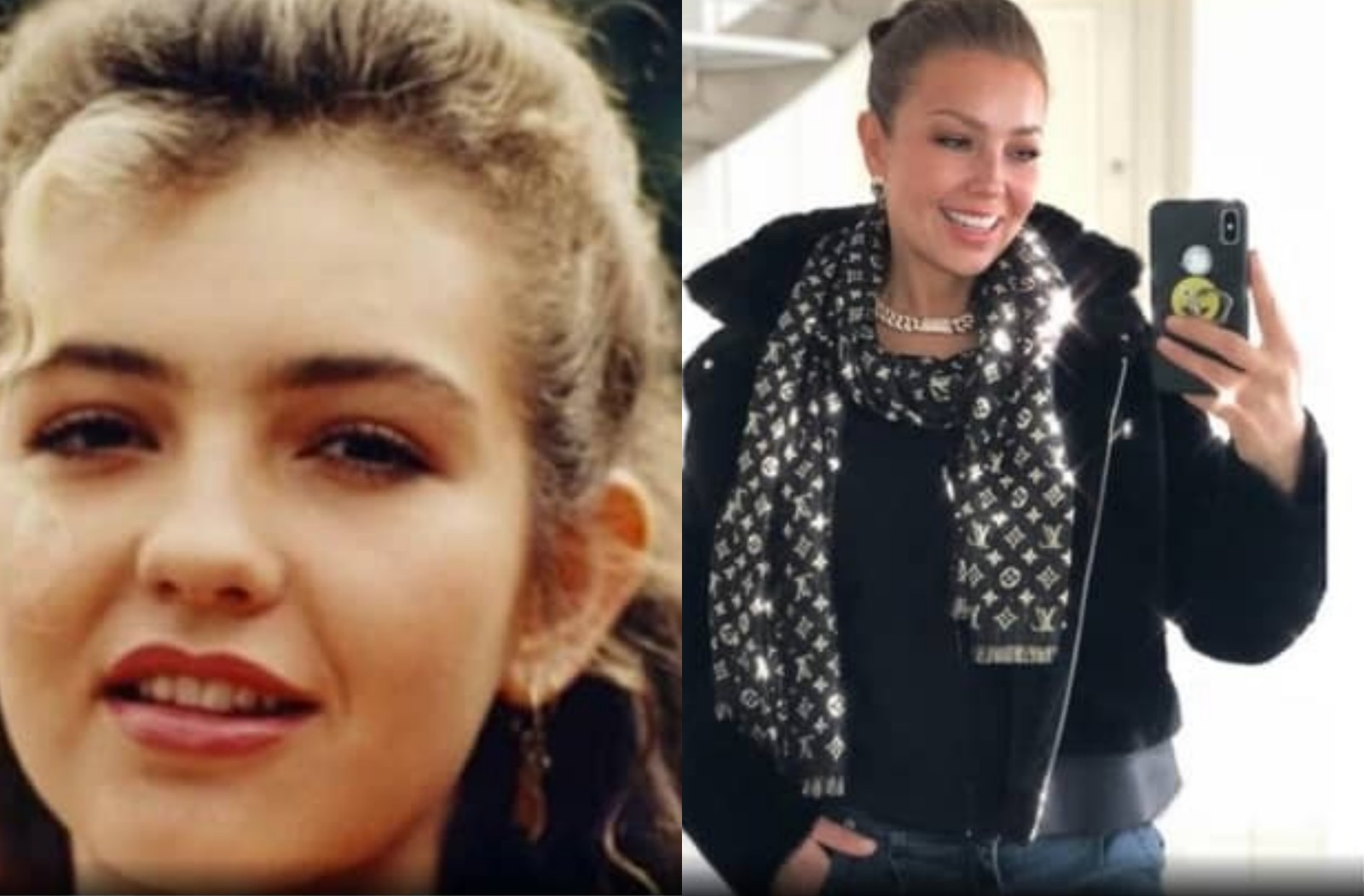 Otoplastia: antes e depois da cantora Thalia