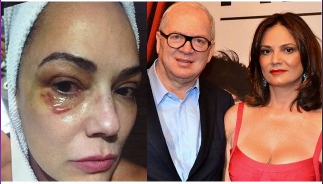 Como ficou o rosto da atriz Luiza Brunet após o então companheiro agredí-la — Foto: Reprodução e Divulgação