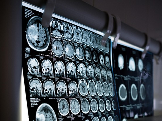 Pesquisadores dos Estados Unidos utilizam inteligência artificial para identificar alterações na anatomia do cérebro de pessoas com autismo.