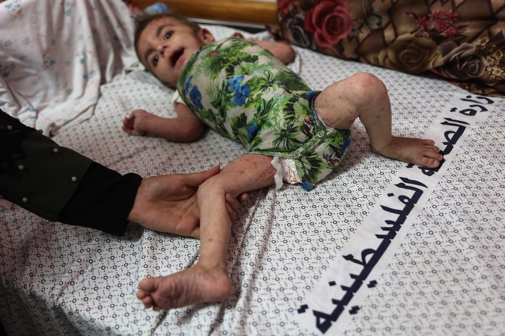 A menina palestina Wateen al-Adasi, que desenvolveu um problema de pele devido à desnutrição, repousa no hospital Kamal Adwan em Beit Lahia, no norte da Faixa de Gaza — Foto: Omar AL-QATTAA/AFP