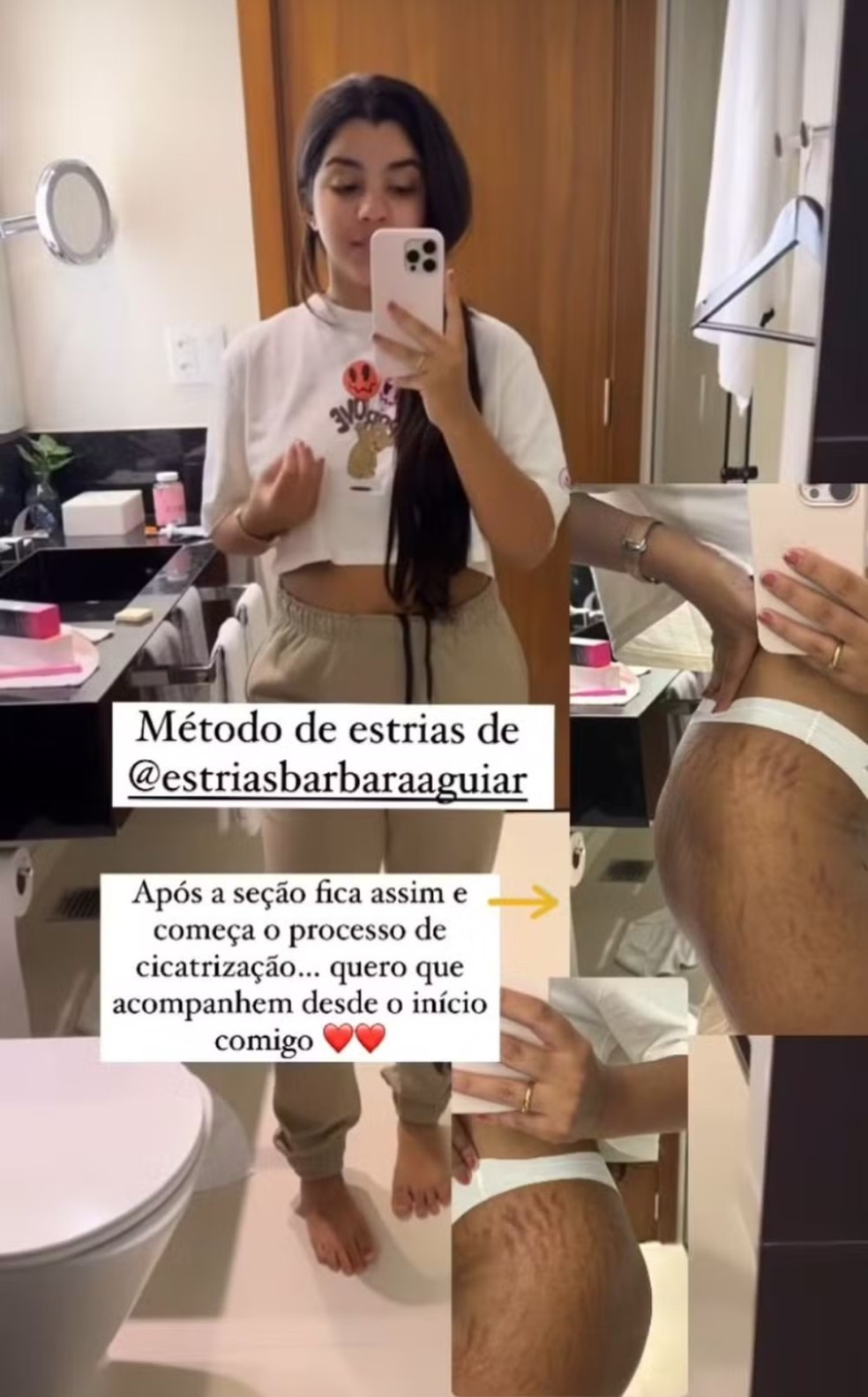 Ary Mirelle mostrou estrias pós-gravidez e iniciou tratamento — Foto: Reprodução Instagram