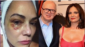 Como ficou o rosto da atriz Luiza Brunet após o então companheiro agredí-la — Foto: Reprodução e Divulgação