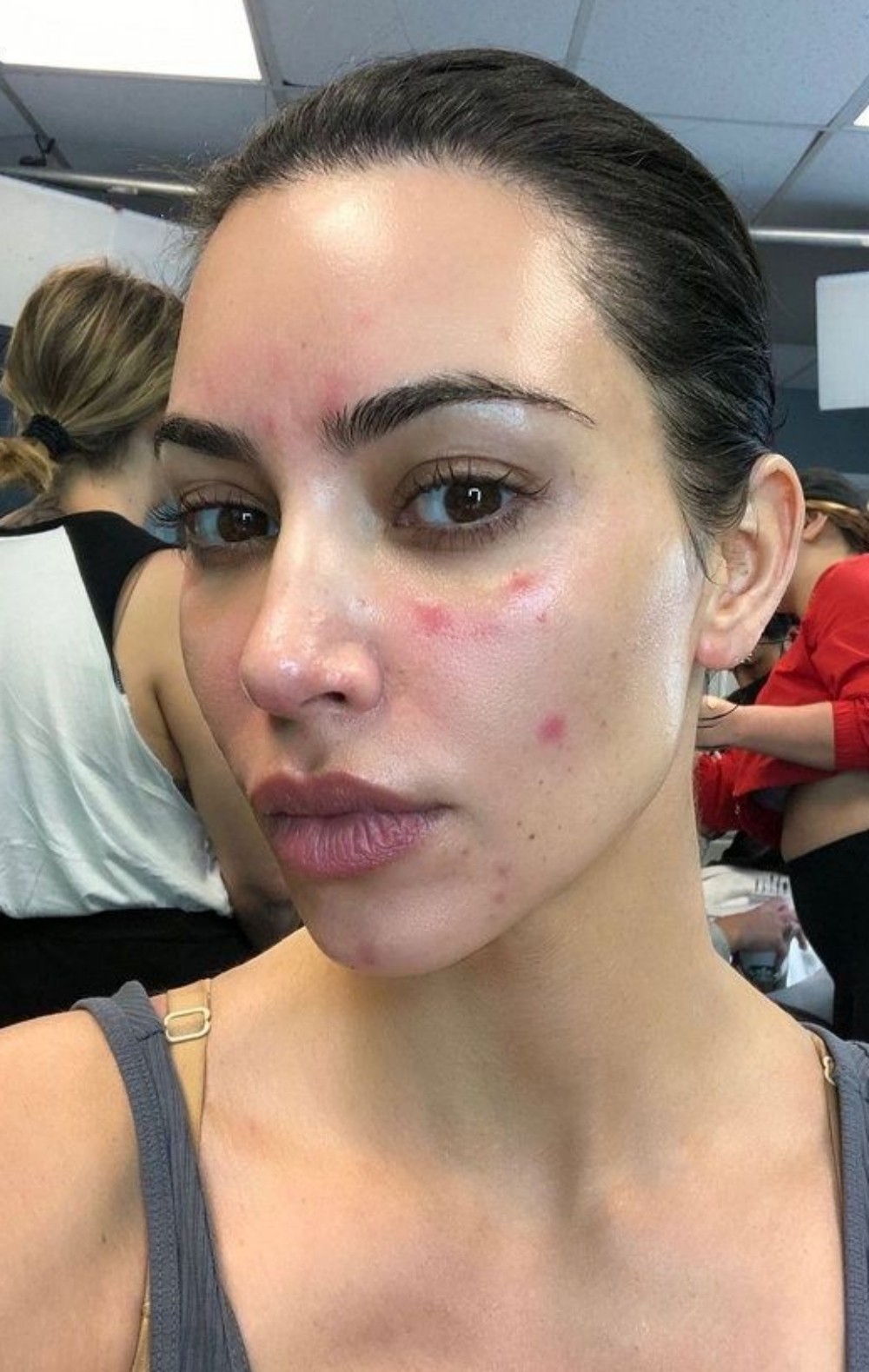 Kim Kardashian já enfrentou problema com acne — Foto: Reprodução Instagram