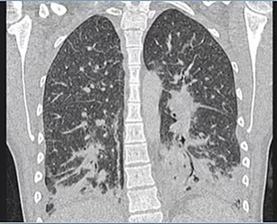 Imagem de Raio-X mostra o pulmão da paciente inflamado e manchado