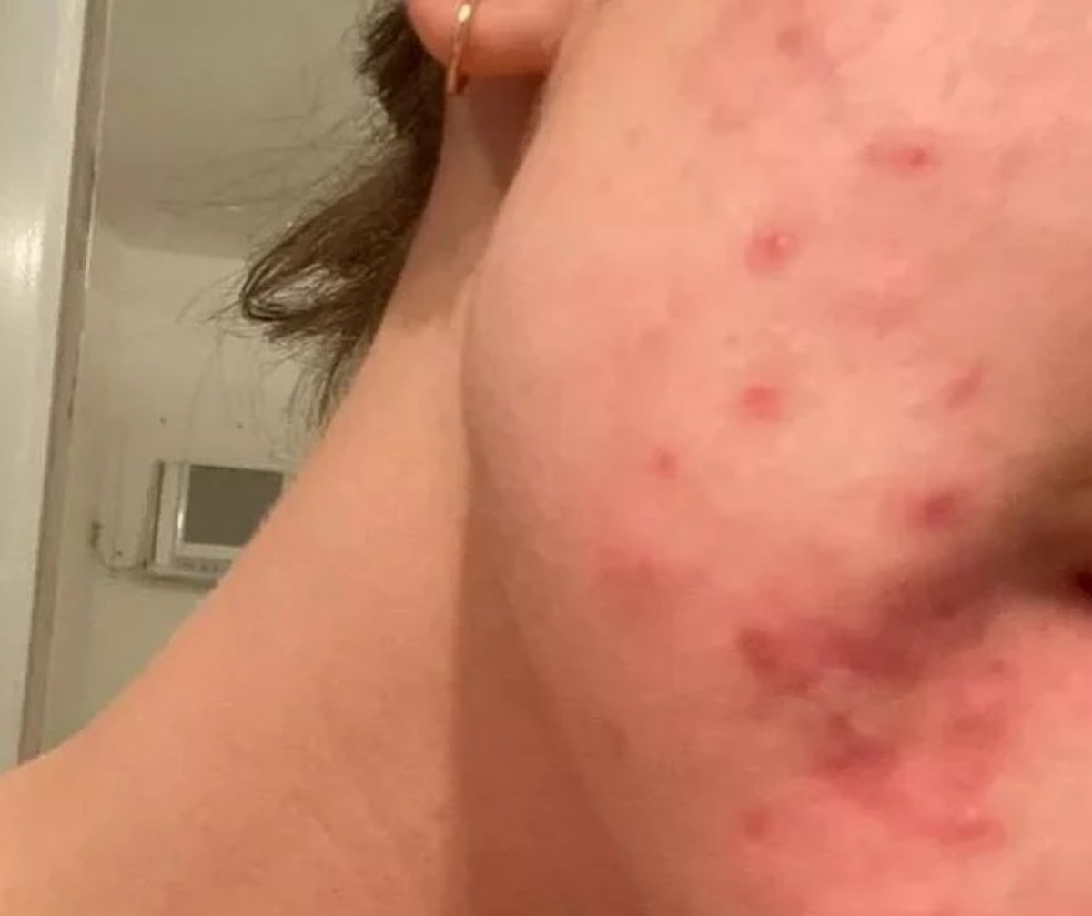 Alice Wegmann já enfrentou problema com acne — Foto: Reprodução Instagram