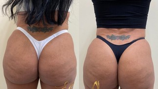 Gretchen exibiu antes e depois do bumbum ao fazer procedimento — Foto: Reprodução Instagram