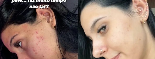 Ana Castela já enfrentou problema com acne — Foto: Reprodução Instagram
