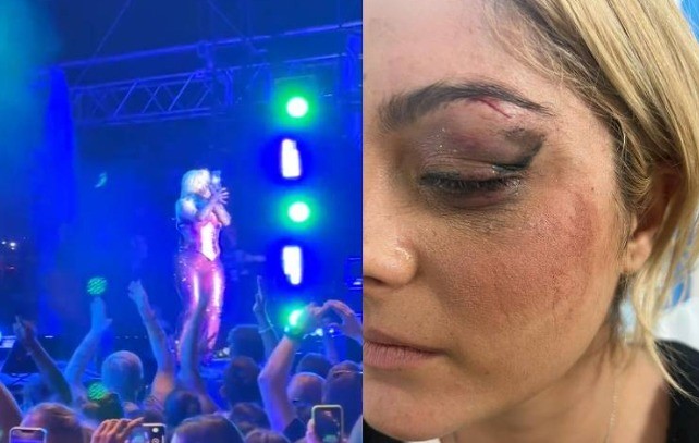 Bebe Rexha precisou interromper um show e chegou a levar pontos na região dos olhos após ter sido atingida por um celular em Nova York em junho deste ano; o agressor foi preso e disse que ter jogado o objeto porque 'pensou que seria engraçado' — Foto: Reprodução