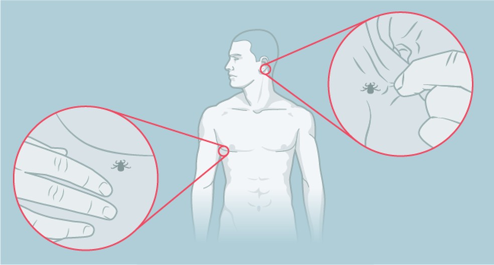 Como tirar o carrapato. Arte O GLOBO — Foto: Arte O GLOBO