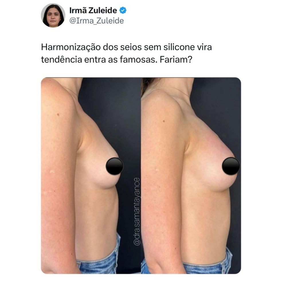 Foto mostra resultado de harmonização de seios  — Foto: Reprodução @irmazuleideoficial