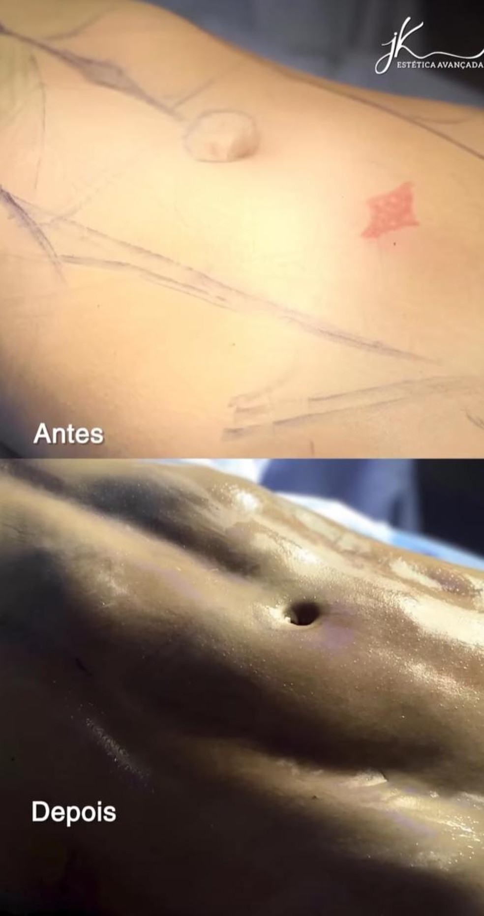 Laís Caldas mostra o antes e depois da lipo LAD — Foto: Reprodução/Instagram