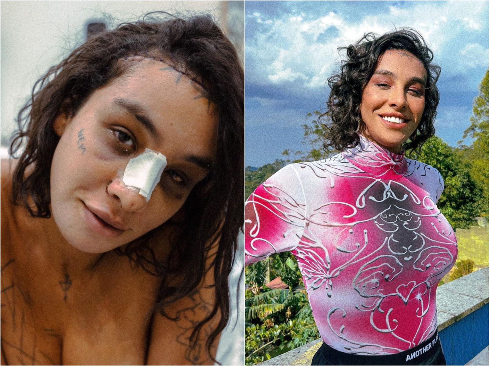 Linn da Quebrada passou por uma cirurgia de reafirmação de gênero e modificou vários pontos do rosto — Foto: Reprodução/Instagram