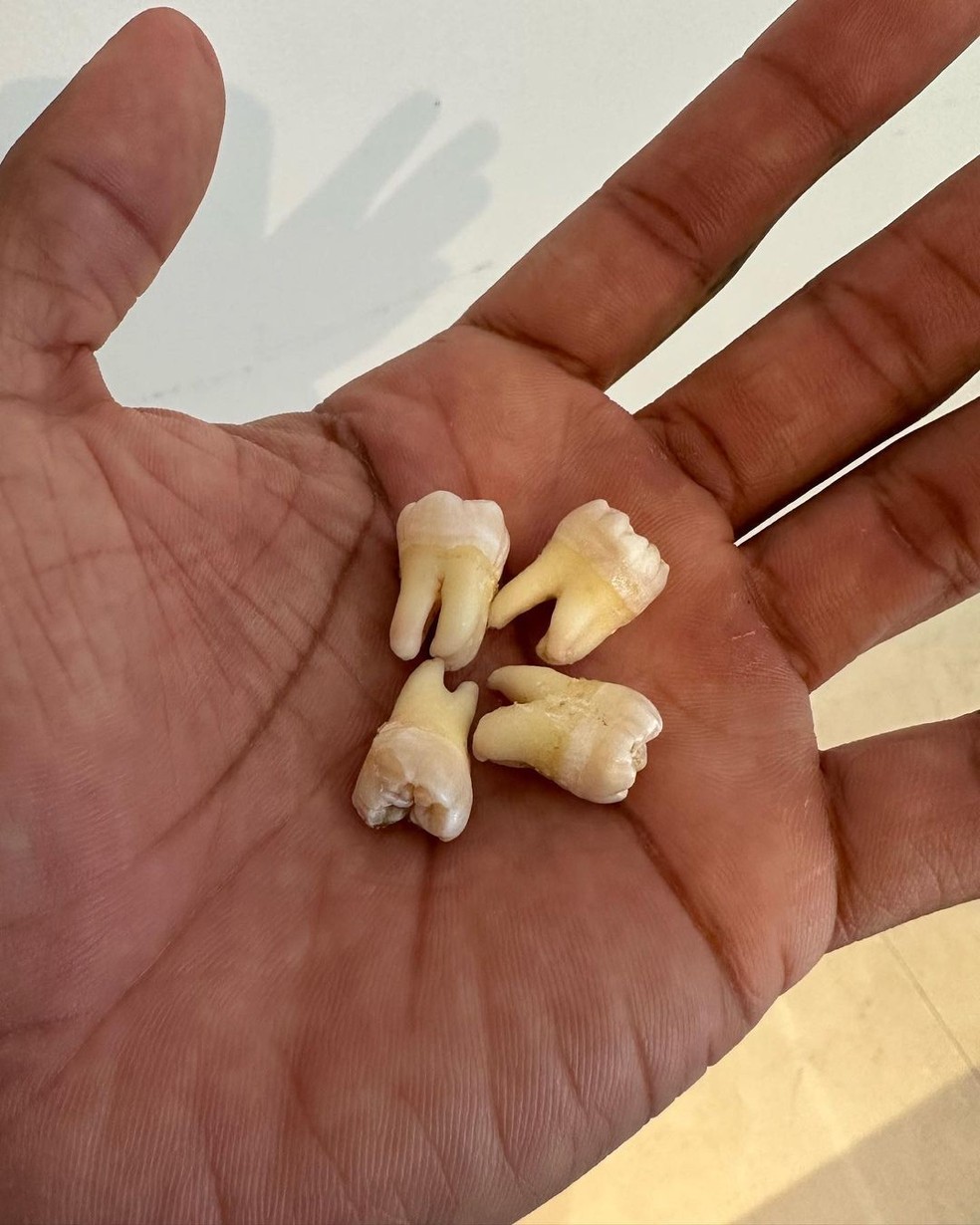 Paulo André mostra os dentes sisos — Foto: Reprodução/Instagram