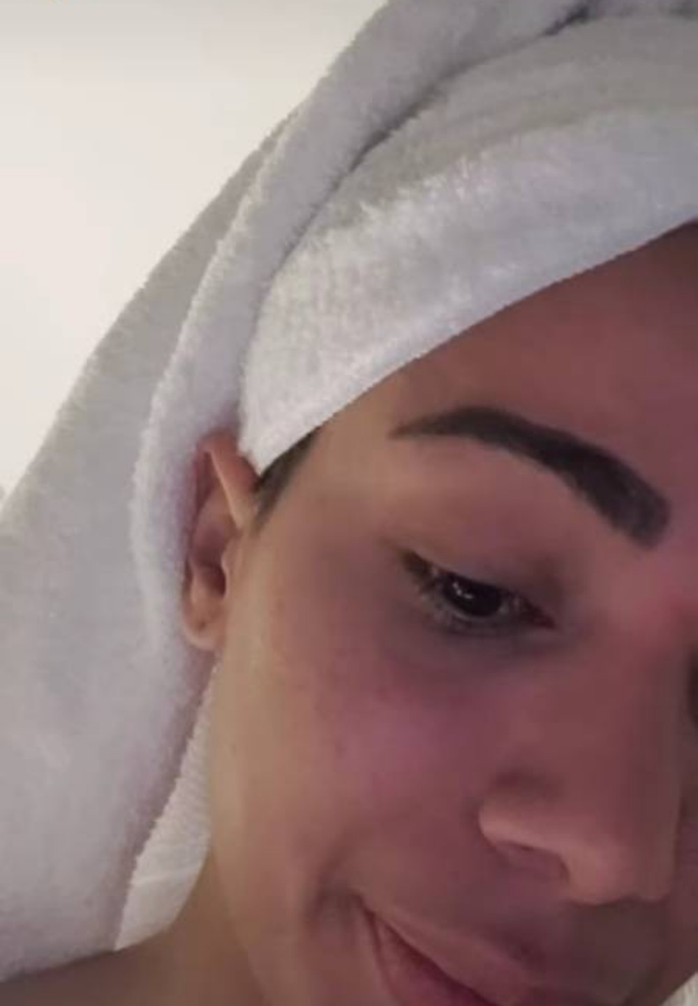 Anitta já enfrentou problema com acne — Foto: Reprodução Instagram