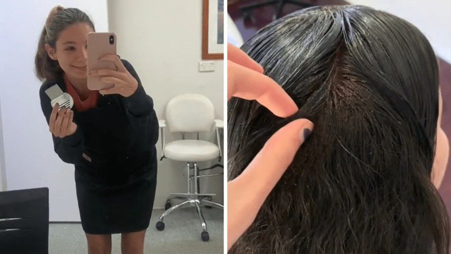 'Moça das Lêndeas': mulher ganha R$ 750 por hora para catar 'super piolhos', na Austrália