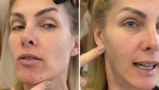 Ana Hickmann já enfrentou problema com acne — Foto: Reprodução Instagram