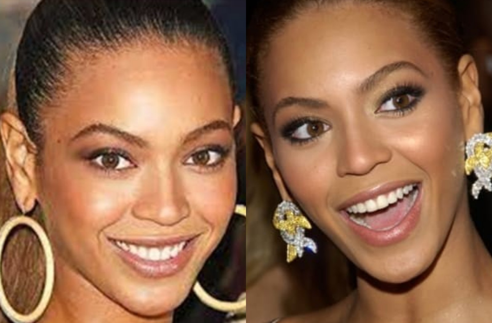 Otoplastia: antes e depois da cantora Beyoncé