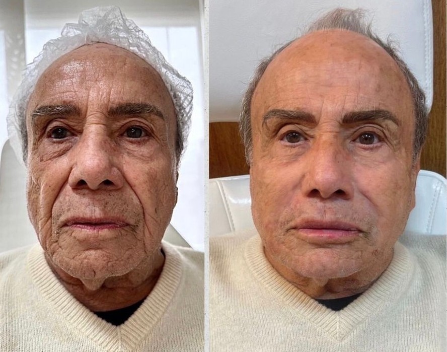 Veja o antes e depois da harmonização facial de Stenio Garcia