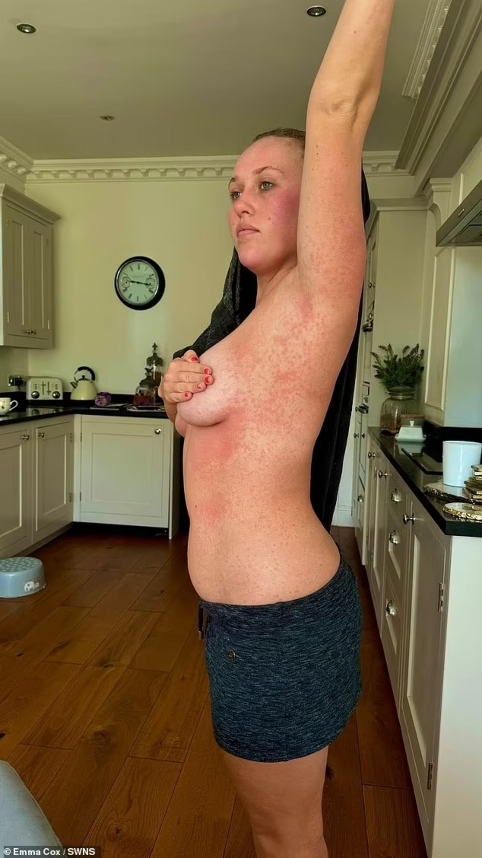 Influenciadora Emma Cox mostrou erupção cutânea cobrindo o seu corpo  — Foto: Reprodução