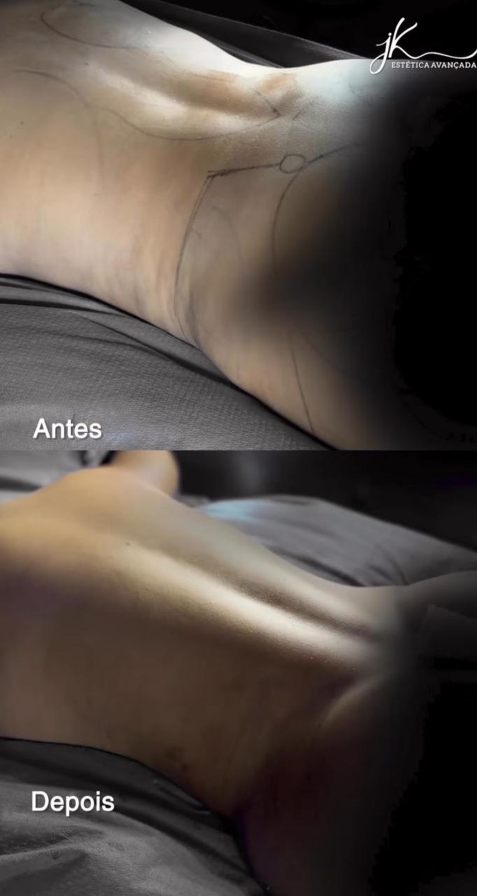 Laís Caldas mostra o antes e depois da lipo LAD — Foto: Reprodução/Instagram