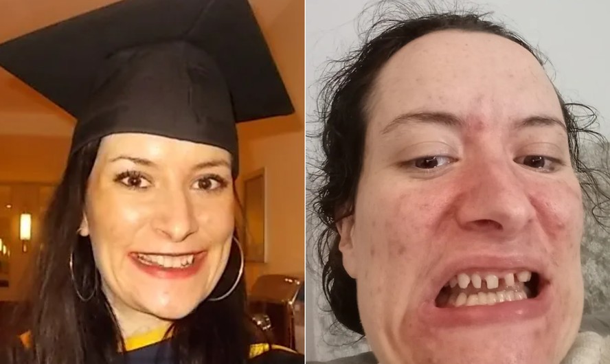 Michelle Waldron sofre de bruxismo há mais de 10 anos e desgastou as duas fileiras de seus dentes devido a condição