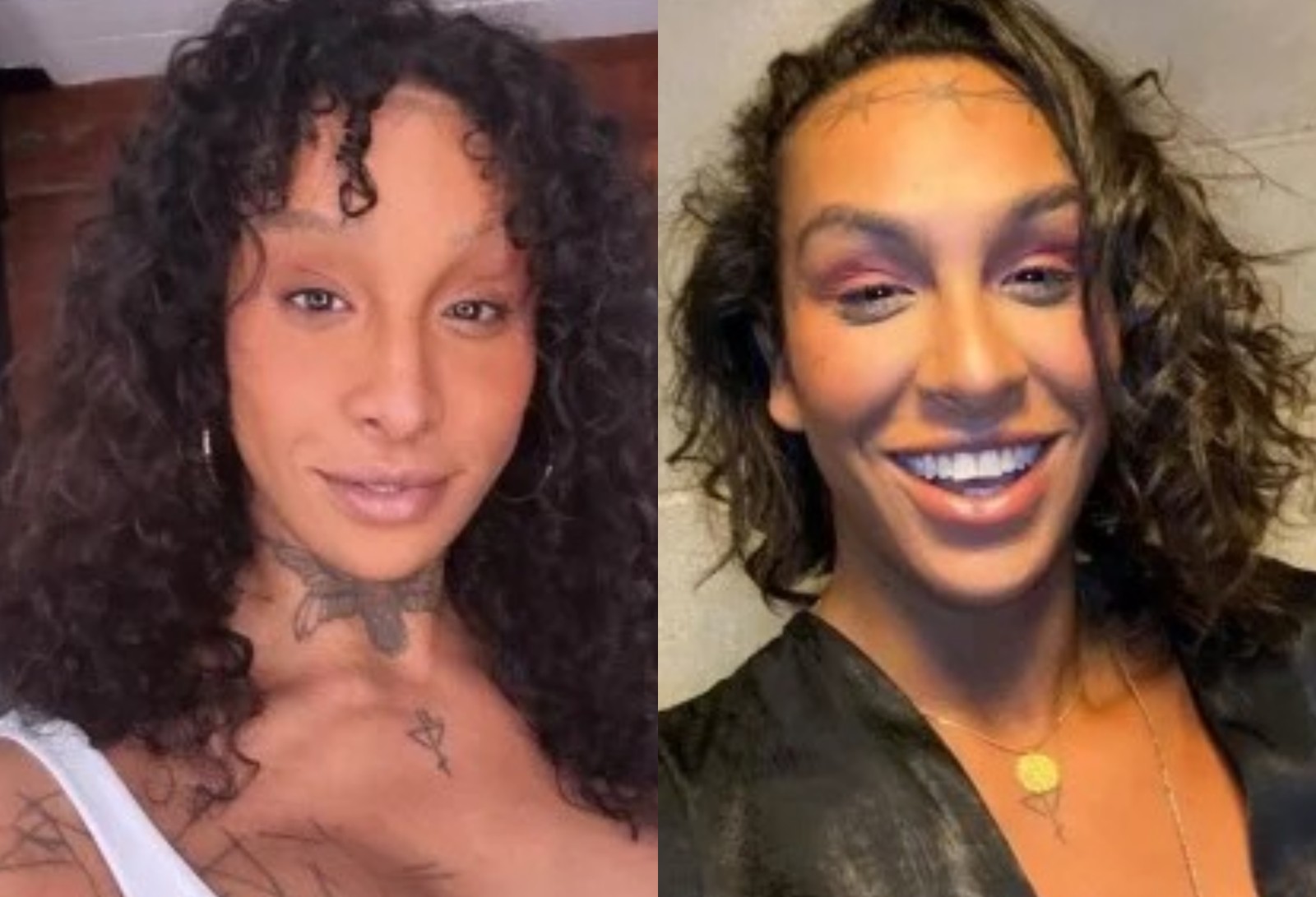  Linn da Quebrada fez a feminização facial com frontoplastia — Foto: Reprodução Instagram