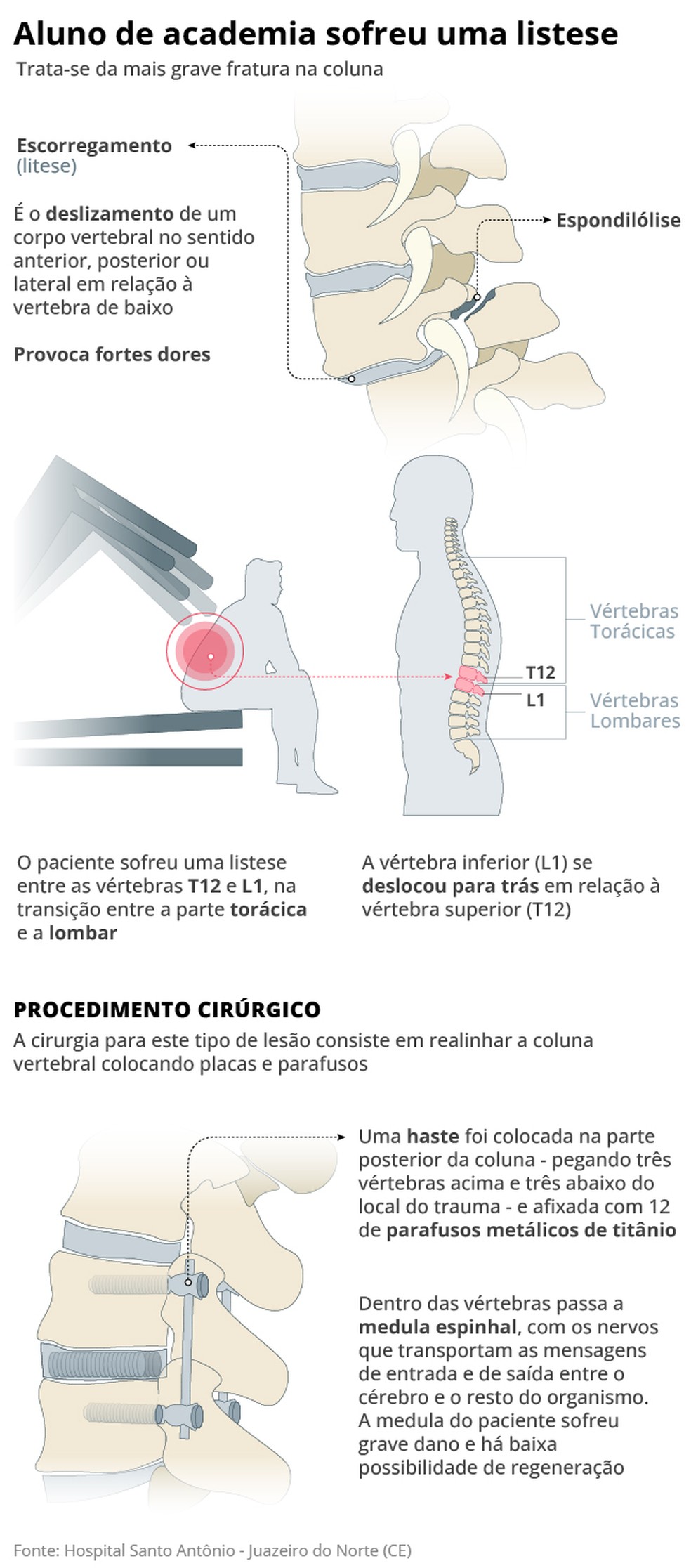 Infográfico mostra como foi a fratura e a cirurgia em aluno de academia que teve a coluna lesionada por aparelho — Foto: Editoria de Arte