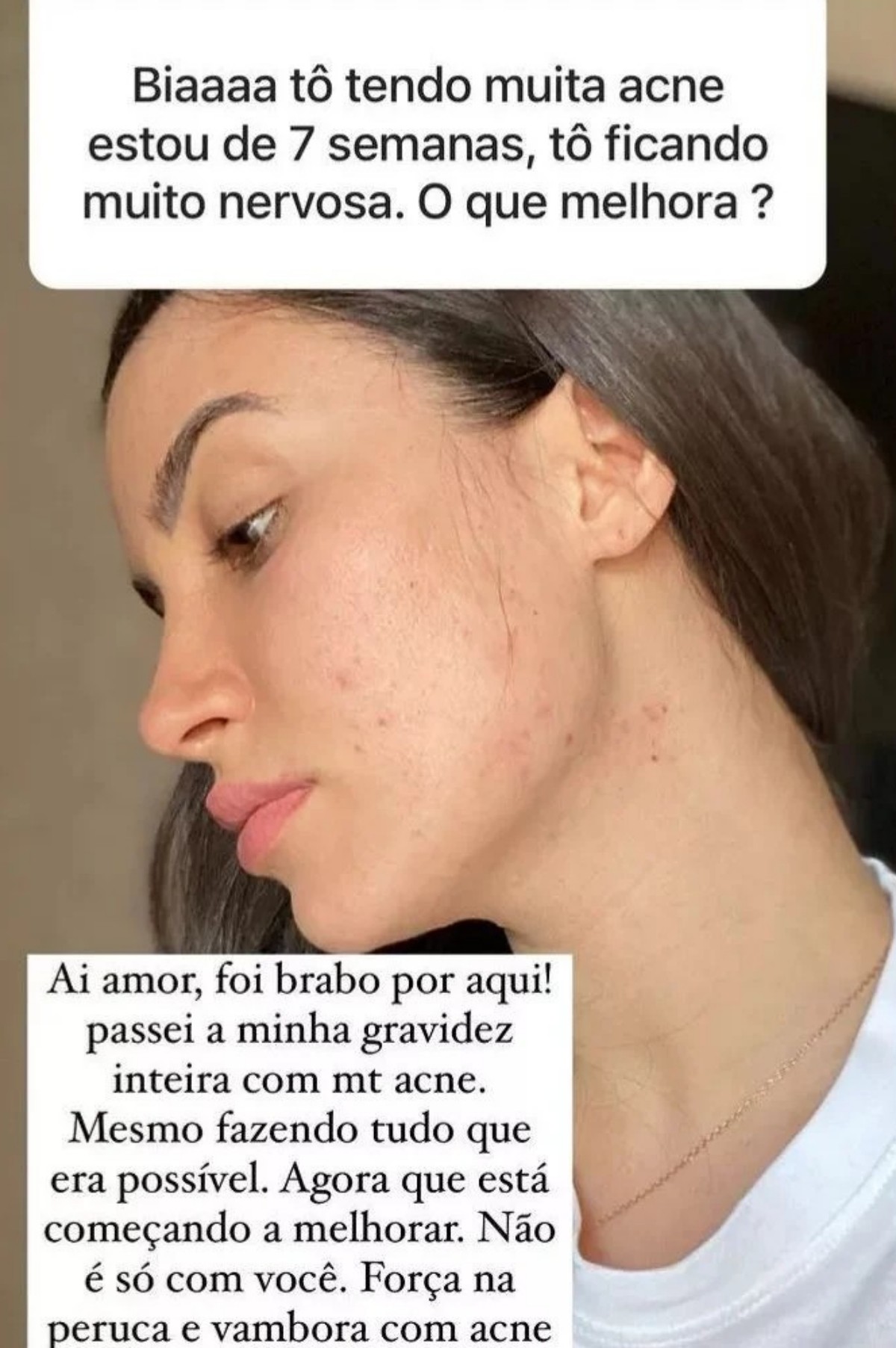 Bianca Andrade já enfrentou problema com acne — Foto: Reprodução Instagram